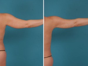 Arm Liposuction | Atlanta | Before and After Photos | Dr. Marcia Byrd