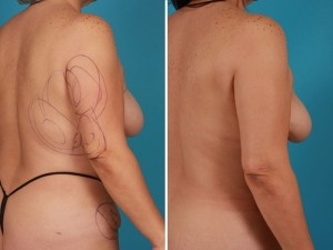 Arm Liposuction | Atlanta | Before and After Photos | Dr. Marcia Byrd