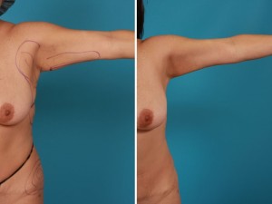 Arm Liposuction | Atlanta | Before and After Photos | Dr. Marcia Byrd