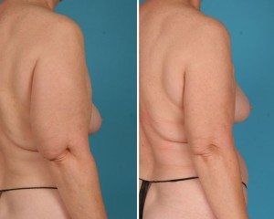 Arm Liposuction | Atlanta | Before and After Photos | Dr. Marcia Byrd