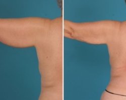 Arm Liposuction | Atlanta | Before and After Photos | Dr. Marcia Byrd