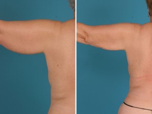 Arm Liposuction | Atlanta | Before and After Photos | Dr. Marcia Byrd