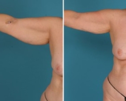 Arm Liposuction | Atlanta | Before and After Photos | Dr. Marcia Byrd