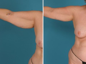 Arm Liposuction | Atlanta | Before and After Photos | Dr. Marcia Byrd