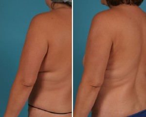 Arm Liposuction | Atlanta | Before and After Photos | Dr. Marcia Byrd