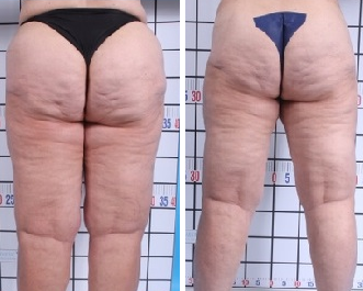 Water Jet-Assisted Liposuction | Before and After Photos | Atlanta | Dr. Marcia Byrd