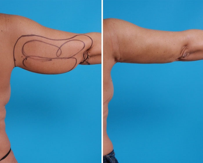 Arm Liposuction| Atlanta | Before and After Photos | Dr. Marcia Byrd