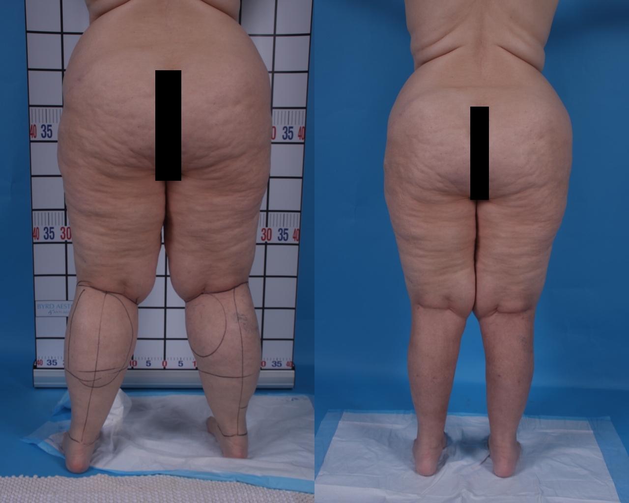 Lipedema before and after