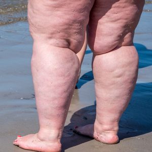 Lipedema