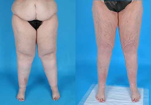 Lipedema before and after