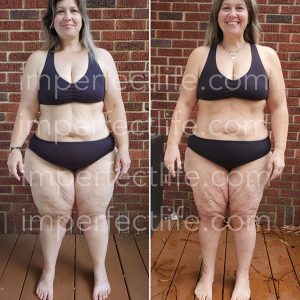 My Lipedema Story