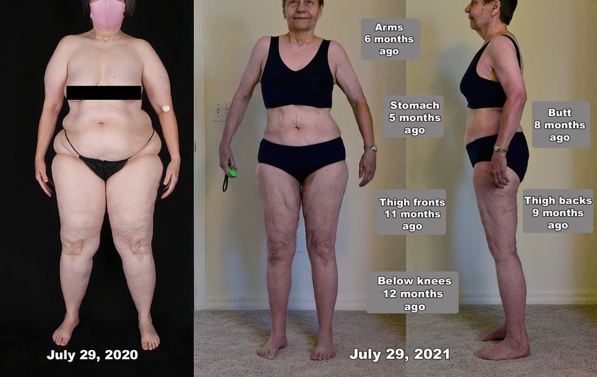 Lipedema Before and After