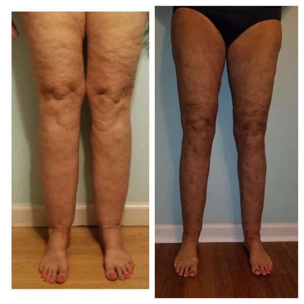 Lipedema Before and after