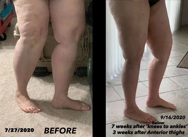 Lipedema before and after photos