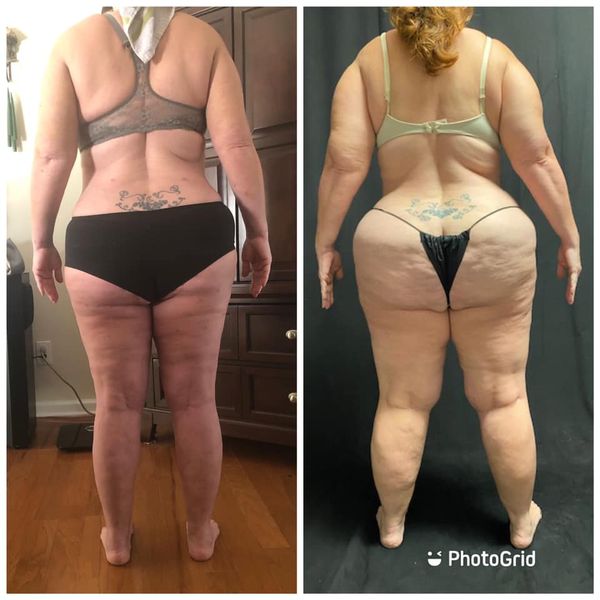 Lipedema Before & After