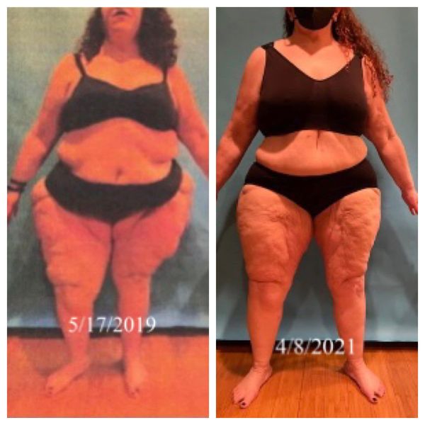 Lipedema before and after photos
