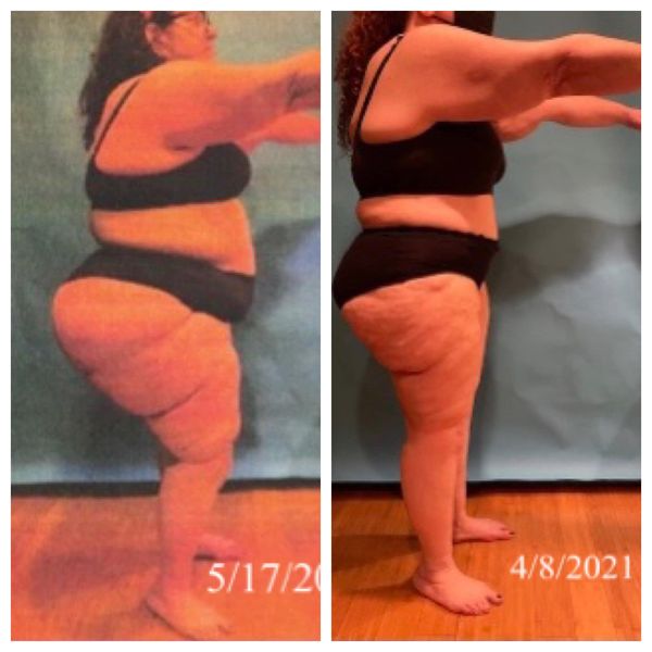 Lipedema Before and After Photo