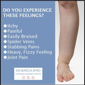 lipedema symptoms