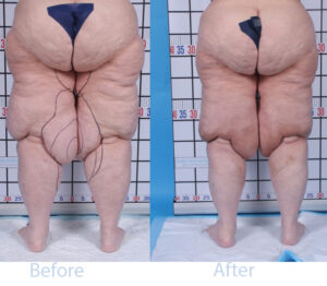 Lipedema Before and After