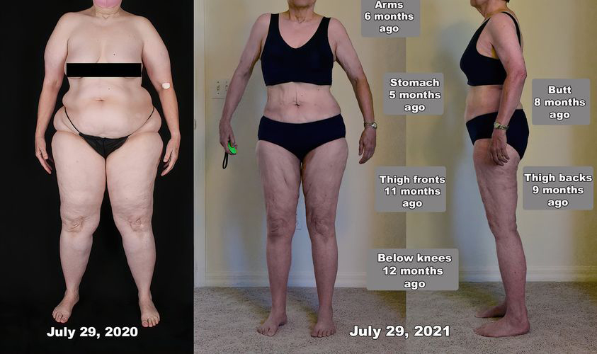 before and after lipedema